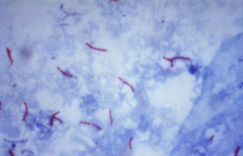 Mycobacterium tuberculosis in sputum, Ziehl–Neelsen stain: thin red rods that keep the red dye through acid alcohol, on a blue background. This is how a clinic confirms TB with a microscope.
