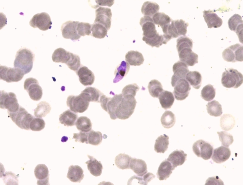 Thin blood smear at 1,000×: the purple crescent is a Plasmodium falciparum gametocyte, the stage a mosquito takes up when it bites; the grey discs are red blood cells.