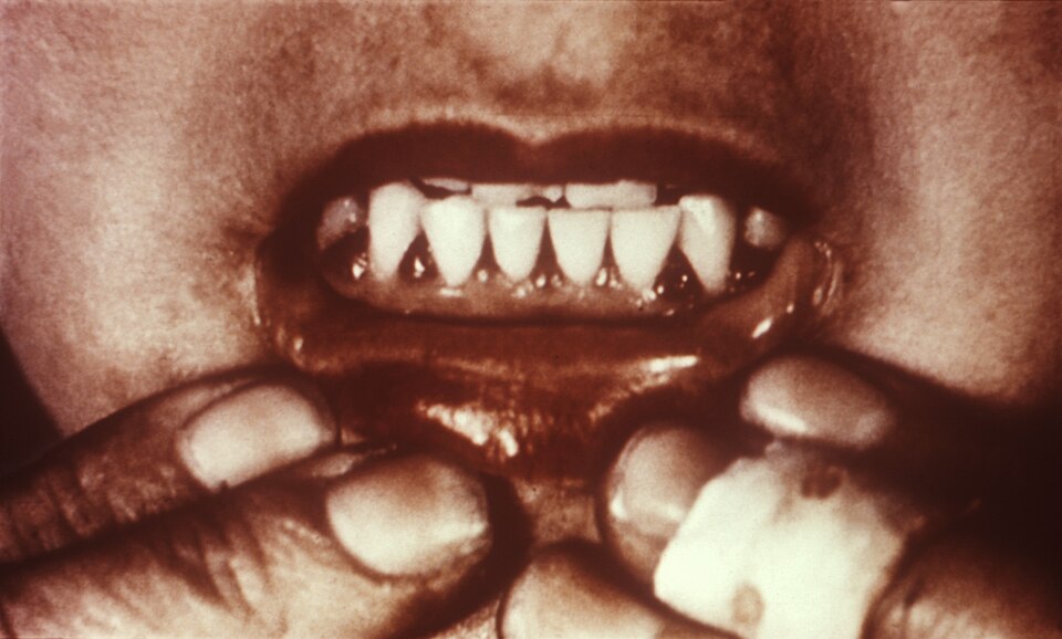Scurvy: gums swollen, dark and spongy between the teeth, bleeding at the gum line. With easy bruising and pinpoint bleeds around the hair follicles of the legs, this is the sign to act on — weeks before scurvy kills.