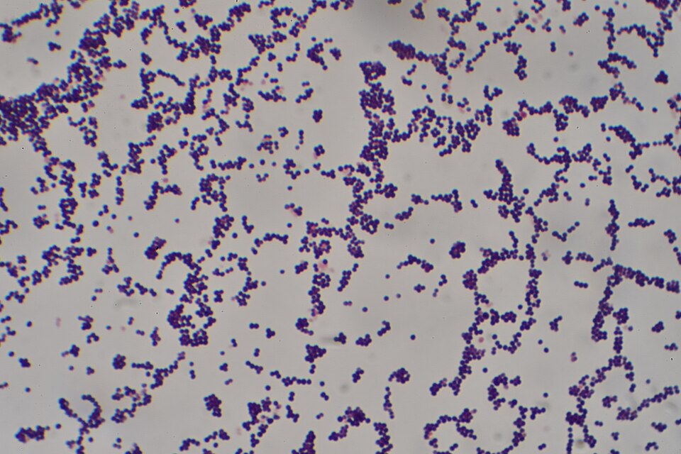 Staphylococcus aureus, Gram stain: purple spheres about 1 µm across in grape-like clusters, the pattern that separates it from Streptococcus, which forms chains.